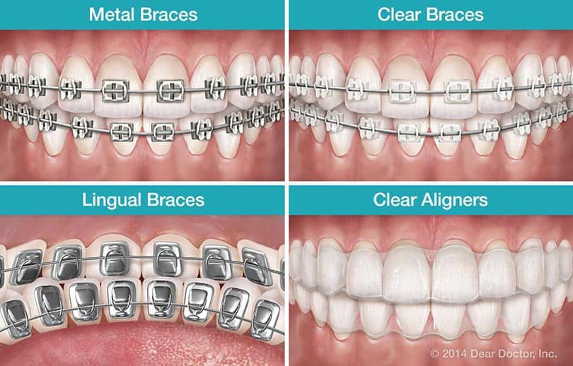 Dental-braces-types