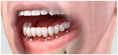 What are the Different Types of Dental Implants