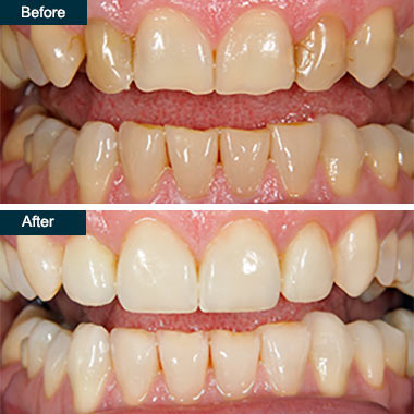 When Is Bonding Application Made To The Teeth?