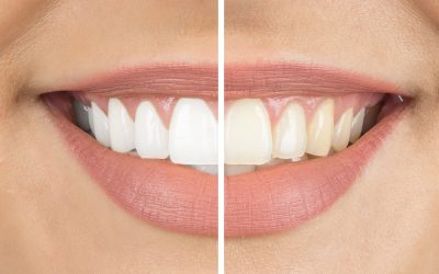Teeth Whitening Application