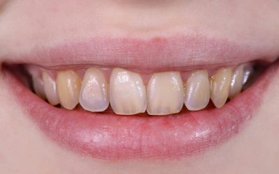 What is Tooth Enamel Wear?
